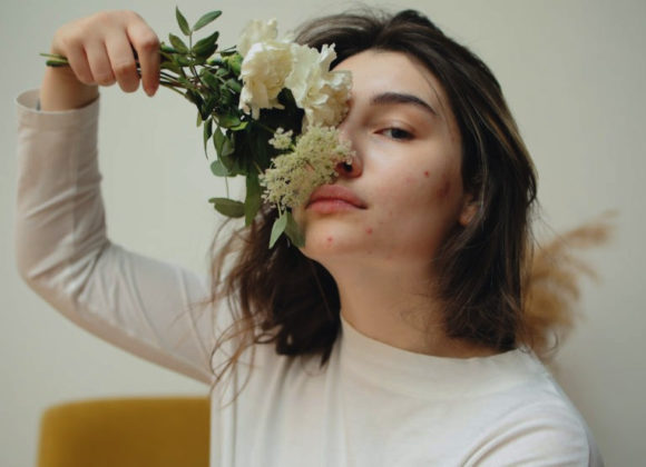 What Years of Acne Struggle Taught Me About Self-Love