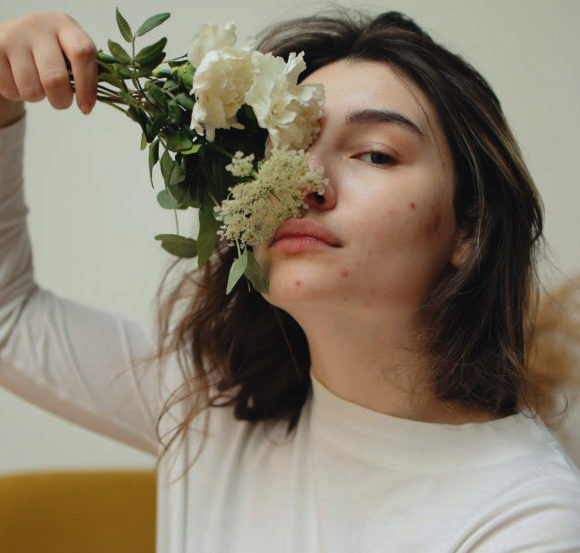 What Years of Acne Struggle Taught Me About Self-Love